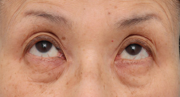 症例写真,目の下のたるみ・黒クマに対して表ハムラ法を行った70代女性の症例写真,施術前,mainpic_hamra004d.jpg