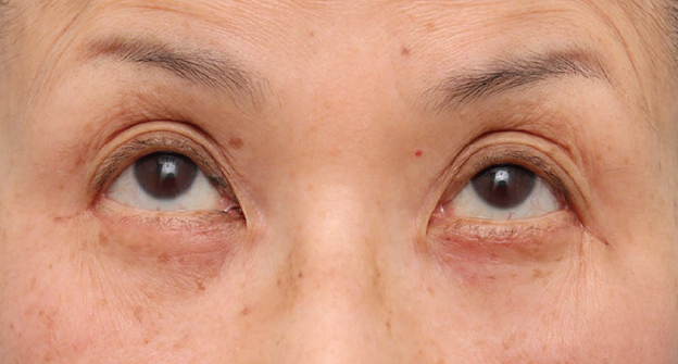 症例写真,目の下のたるみ・黒クマに対して表ハムラ法を行った70代女性の症例写真,1ヶ月後,mainpic_hamra004f.jpg
