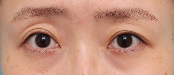 症例写真,二重まぶた・埋没法を行ったことがある患者様に、二重まぶた・全切開法を行った症例写真,After（3ヶ月後）,ba_sekkai119_b01.jpg