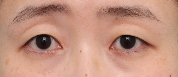 症例写真,二重まぶた・埋没法を行ったことがある患者様に、二重まぶた・全切開法を行った症例写真,Before,ba_sekkai119_b01.jpg