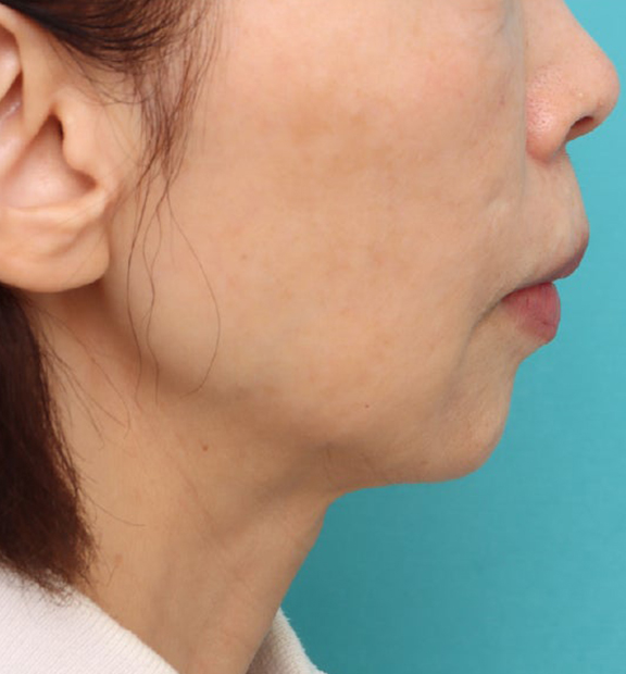 頬をふっくら・ヒアルロン酸注射,注射式シワ取り 長期持続型ヒアルロン酸注入,ヒアルロン酸注射で輪郭を自然な形で整えた症例写真,After（8ヶ月後）,ba_hyaluronic040_a01.jpg