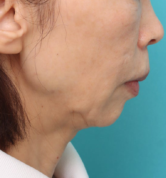 頬をふっくら・ヒアルロン酸注射,注射式シワ取り 長期持続型ヒアルロン酸注入,ヒアルロン酸注射で輪郭を自然な形で整えた症例写真,Before,ba_hyaluronic040_b01.jpg