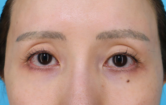 くぼみ目修正（ヒアルロン酸注射）,目元に自然なボリュームを持たせたくぼみ目修正（ヒアルロン酸注射）の症例写真,Before,ba_kubomi013_b01.jpg