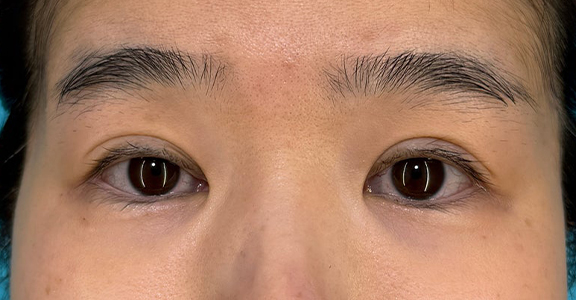 サーマクールアイ,サーマクールアイFLXでまぶたの窪みが改善した症例写真,After（1ヶ月後）,ba_thermacool_eye010_a01.jpg