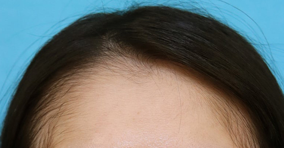 AGA治療（高須式メディカル育毛プログラム）,女性の薄毛治療,女性の薄毛治療（PRP育毛治療）の症例写真,After（3ヶ月後）,ba_aga_josei006_a01.jpg