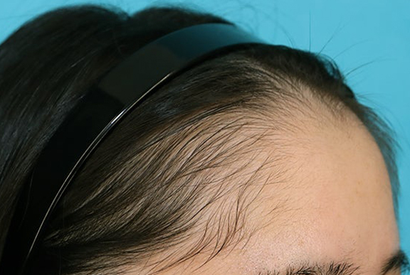 症例写真,女性の薄毛治療（PRP育毛治療）の症例写真,After（3ヶ月後）,ba_aga_josei006_b02.jpg