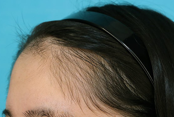 症例写真,女性の薄毛治療（PRP育毛治療）の症例写真,After（3ヶ月後）,ba_aga_josei006_b03.jpg
