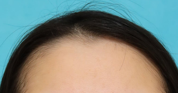 AGA治療（高須式メディカル育毛プログラム）,女性の薄毛治療,女性の薄毛治療（PRP育毛治療）の症例写真,Before,ba_aga_josei006_b01.jpg