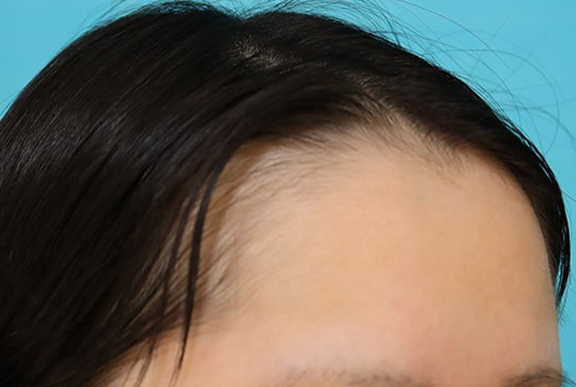 症例写真,女性の薄毛治療（PRP育毛治療）の症例写真,Before,ba_aga_josei006_b02.jpg