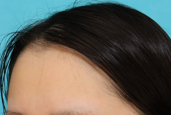 症例写真,女性の薄毛治療（PRP育毛治療）の症例写真,Before,ba_aga_josei006_b03.jpg