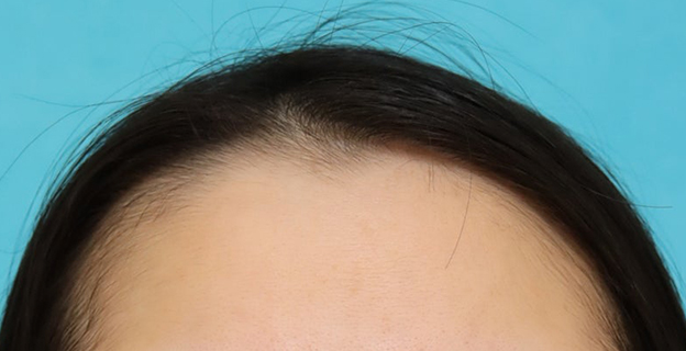 症例写真,女性の薄毛治療（PRP育毛治療）の症例写真,施術前,mainpic_aga_josei006a.jpg