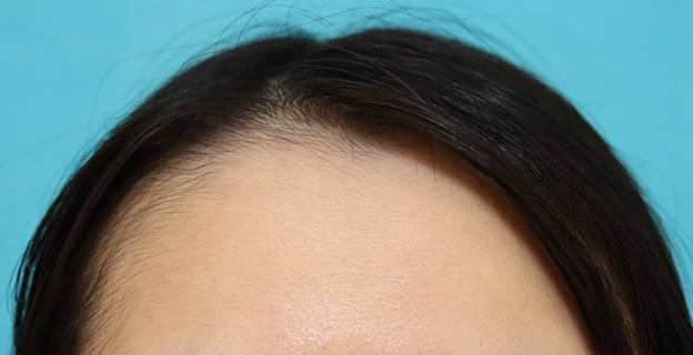 症例写真,女性の薄毛治療（PRP育毛治療）の症例写真,1ヶ月後,mainpic_aga_josei006b.jpg