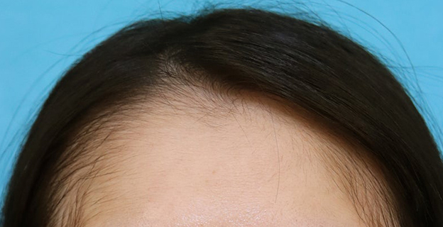 症例写真,女性の薄毛治療（PRP育毛治療）の症例写真,3ヶ月後,mainpic_aga_josei006c.jpg