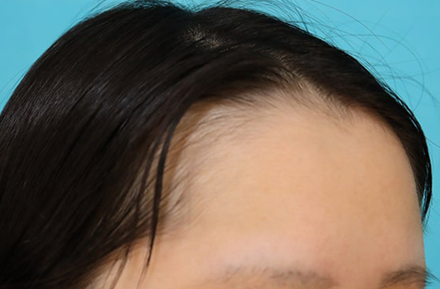 症例写真,女性の薄毛治療（PRP育毛治療）の症例写真,施術前,mainpic_aga_josei006d.jpg