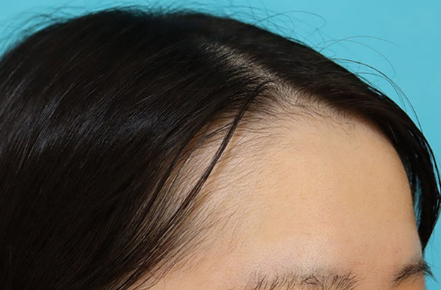 症例写真,女性の薄毛治療（PRP育毛治療）の症例写真,1ヶ月後,mainpic_aga_josei006e.jpg