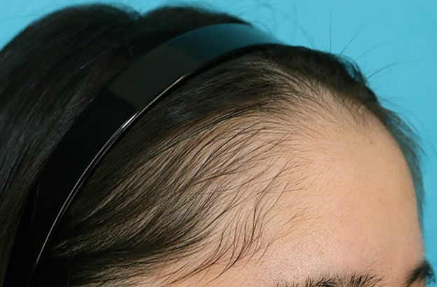 症例写真,女性の薄毛治療（PRP育毛治療）の症例写真,3ヶ月後,mainpic_aga_josei006f.jpg