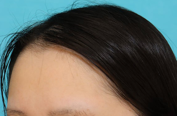 症例写真,女性の薄毛治療（PRP育毛治療）の症例写真,施術前,mainpic_aga_josei006g.jpg