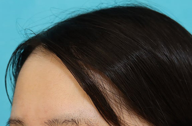 症例写真,女性の薄毛治療（PRP育毛治療）の症例写真,1ヶ月後,mainpic_aga_josei006h.jpg