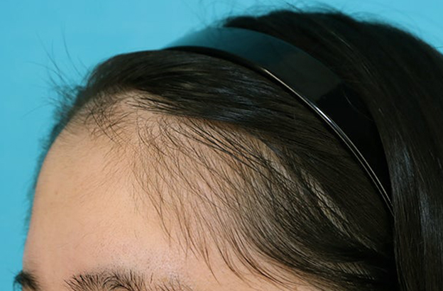 症例写真,女性の薄毛治療（PRP育毛治療）の症例写真,3ヶ月後,mainpic_aga_josei006i.jpg