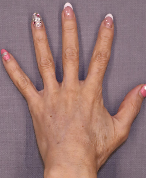 手の甲にヒアルロン酸を注入した症例写真,After（1ヶ月後）,ba_hyaluronic041_a01.jpg