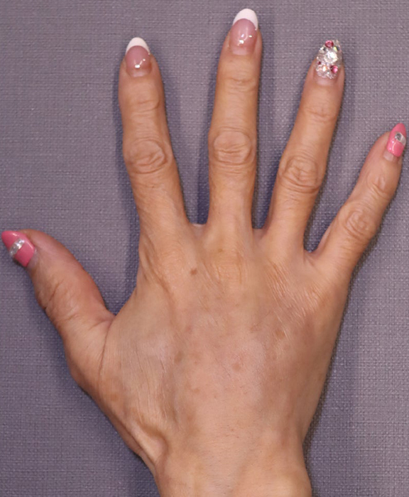 症例写真,手の甲にヒアルロン酸を注入した症例写真,After（1ヶ月後）,ba_hyaluronic041_b02.jpg
