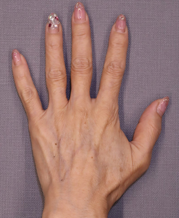 手の甲にヒアルロン酸を注入した症例写真,Before,ba_hyaluronic041_b01.jpg