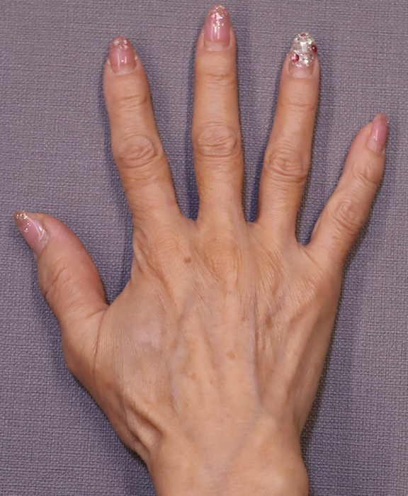 症例写真,手の甲にヒアルロン酸を注入した症例写真,Before,ba_hyaluronic041_b02.jpg