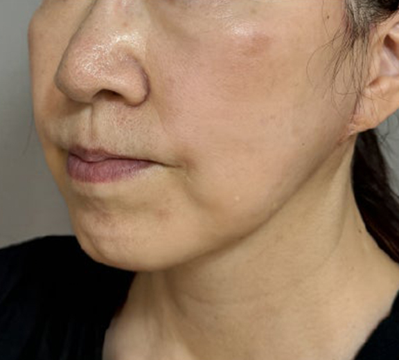 脂肪吸引（頬、あご下）,ミニフェイスリフト（頬のたるみ取り）,脂肪吸引,ミニフェイスリフトと顎下脂肪吸引の症例写真,After（6ヶ月後）,ba_minilift031_a01.jpg
