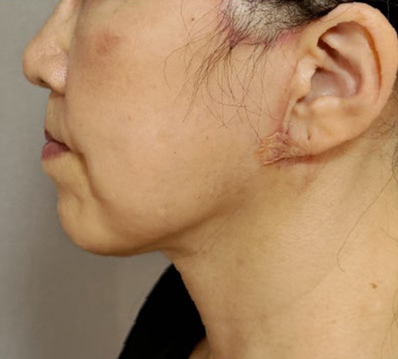 症例写真,ミニフェイスリフトと顎下脂肪吸引の症例写真,After（6ヶ月後）,ba_minilift031_b02.jpg