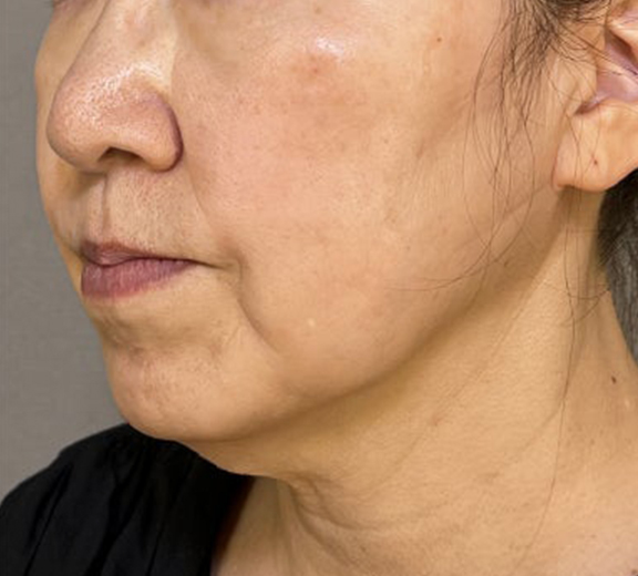 脂肪吸引（頬、あご下）,ミニフェイスリフト（頬のたるみ取り）,脂肪吸引,ミニフェイスリフトと顎下脂肪吸引の症例写真,Before,ba_minilift031_b01.jpg
