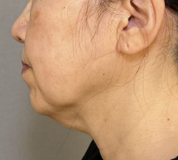 症例写真,ミニフェイスリフトと顎下脂肪吸引の症例写真,Before,ba_minilift031_b02.jpg