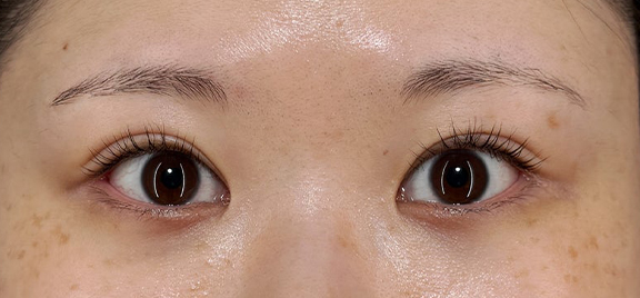 二重まぶた・全切開法+目頭切開+目尻切開を行った症例写真,After（6ヶ月後）,ba_sekkai120_a01.jpg