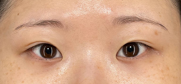 二重まぶた・全切開法+目頭切開+目尻切開を行った症例写真,Before,ba_sekkai120_b01.jpg