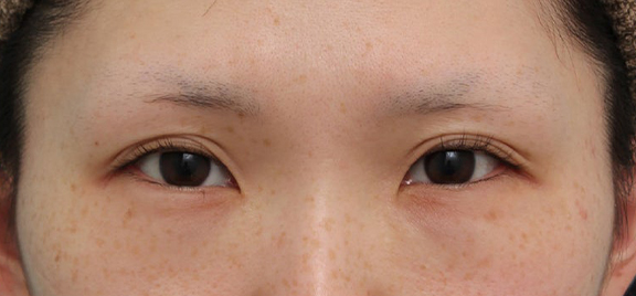 二重まぶた・埋没法（二針固定）で食い込みのあった二重を整えた症例写真,Before,ba_maibotsu095_b01.jpg