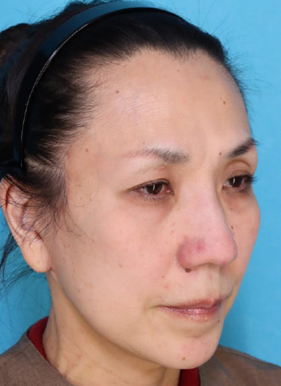 症例写真,あご下から頸部をリフトアップしたフルフェイスリフトの症例写真,After（3ヶ月後）,ba_facelift011_b02.jpg