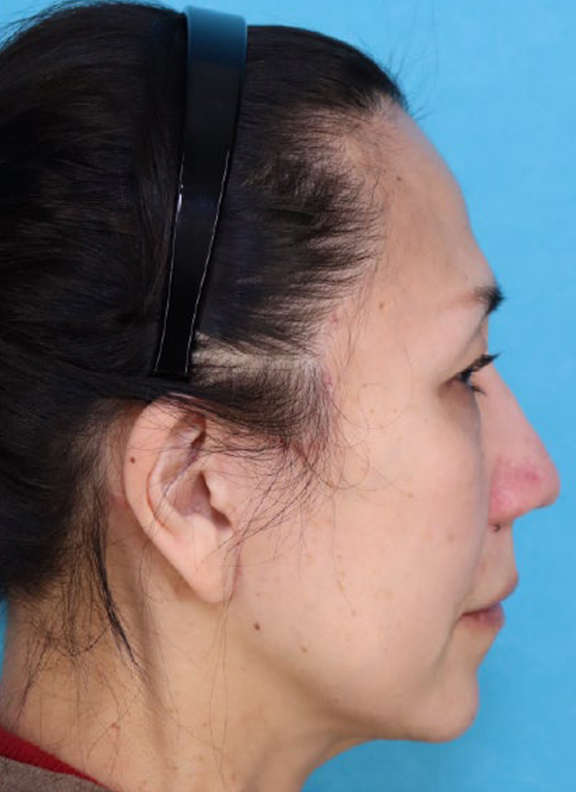症例写真,あご下から頸部をリフトアップしたフルフェイスリフトの症例写真,After（3ヶ月後）,ba_facelift011_b03.jpg