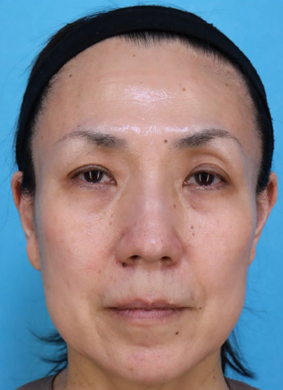フルフェイスリフト,あご下から頸部をリフトアップしたフルフェイスリフトの症例写真,Before,ba_facelift011_b01.jpg