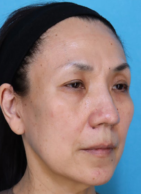 症例写真,あご下から頸部をリフトアップしたフルフェイスリフトの症例写真,Before,ba_facelift011_b02.jpg