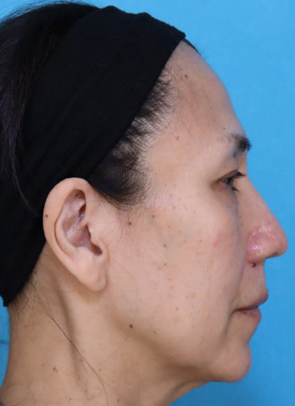 症例写真,あご下から頸部をリフトアップしたフルフェイスリフトの症例写真,Before,ba_facelift011_b03.jpg