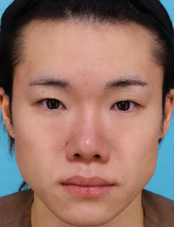 二重全切開＋目頭切開で二重を形成した20代男性の症例写真,Before,ba_sekkai121_b01.jpg