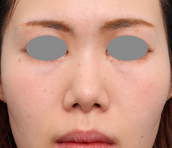 耳介軟骨移植で鼻中下降した30代女性のダウンタイム症例写真,After（2週間後）,ba_jikai062_a01.jpg