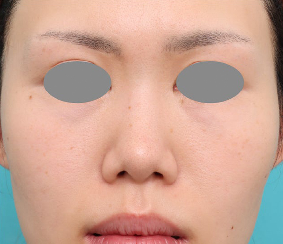 耳介軟骨移植で鼻中下降した30代女性のダウンタイム症例写真,Before,ba_jikai062_b01.jpg