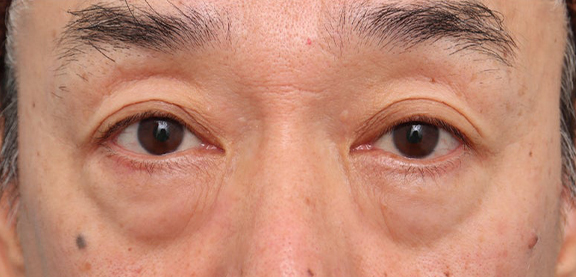 表ハムラ・裏ハムラ法,表ハムラ法で涙袋を形成した70代男性のダウンタイム中の症例写真,Before,ba_hamra005_b01.jpg