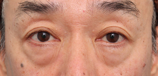 症例写真,表ハムラ法で涙袋を形成した70代男性のダウンタイム中の症例写真,施術前,mainpic_hamra005a.jpg