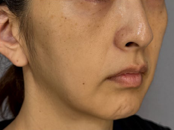 フルフェイスリフト,フェイスリフトで顔のボリュームを整えた術後1ヶ月の症例写真,Before,ba_facelift012_b01.jpg