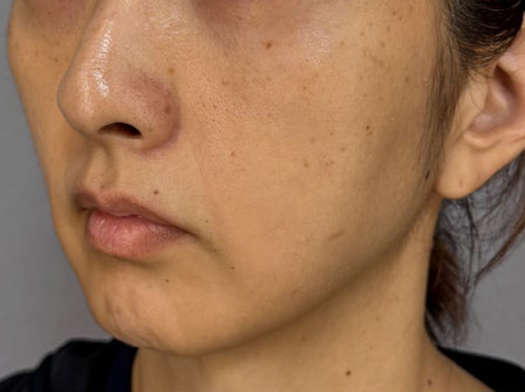 症例写真,フェイスリフトで顔のボリュームを整えた術後1ヶ月の症例写真,Before,ba_facelift012_b02.jpg