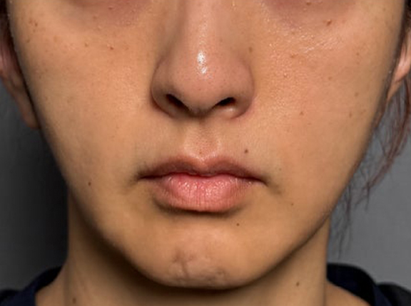 症例写真,フェイスリフトで顔のボリュームを整えた術後1ヶ月の症例写真,Before,ba_facelift012_b03.jpg