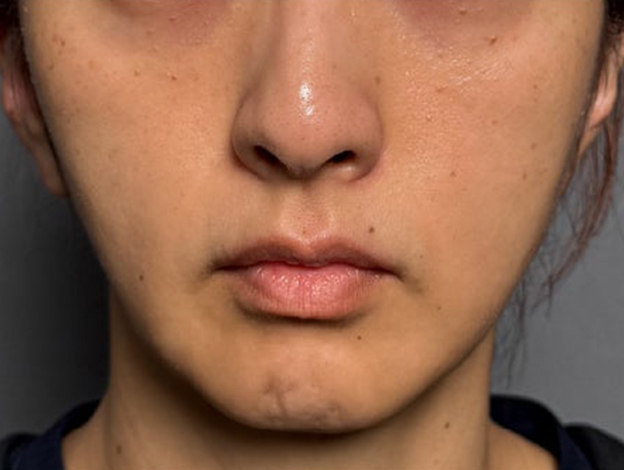 症例写真,フェイスリフトで顔のボリュームを整えた術後1ヶ月の症例写真,施術前,mainpic_facelift012a.jpg