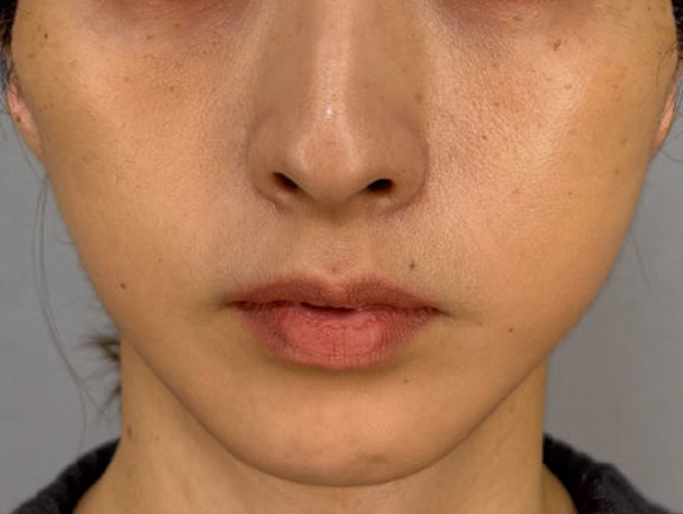症例写真,フェイスリフトで顔のボリュームを整えた術後1ヶ月の症例写真,1ヶ月後,mainpic_facelift012b.jpg