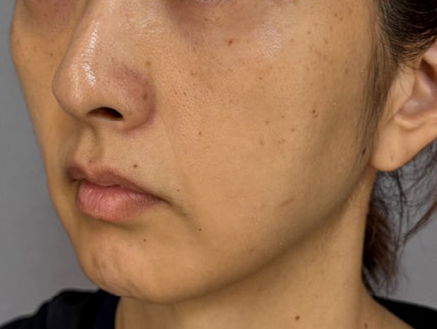 症例写真,フェイスリフトで顔のボリュームを整えた術後1ヶ月の症例写真,施術前,mainpic_facelift012d.jpg